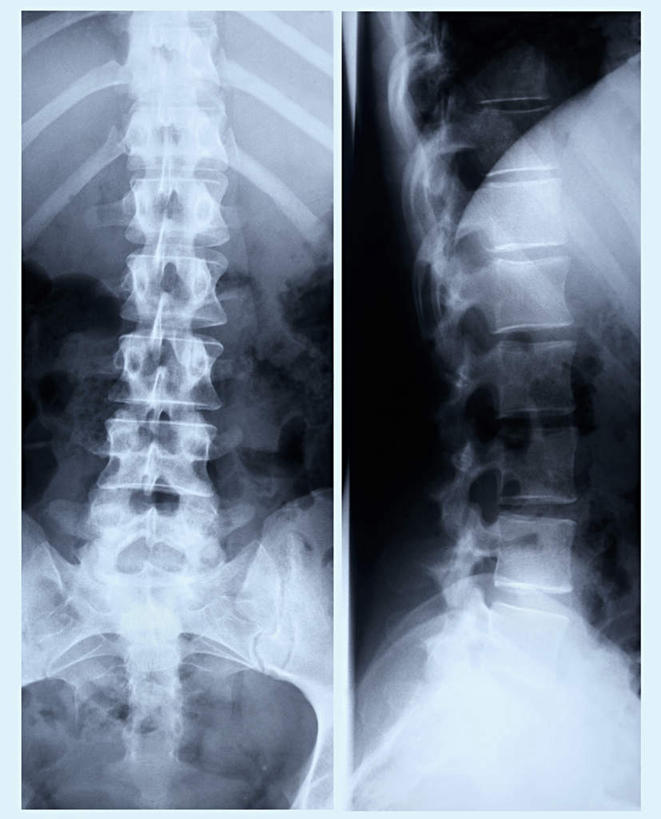 脊髓,骨骼,无人,竖图,x光片,室内,特写,白天,正面,静物,黑色背景,辐射,科学,医学,骨头,骨架,医疗,科学技术,x射线,x光,脊柱,彩图,电磁波,电磁辐射
