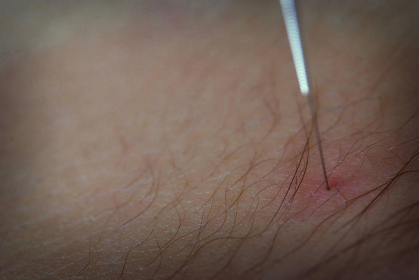 成年人,一个人,病人,横图,特写,仅一个男性,仅一个人,锐利,英格兰,仅一个年轻男性,摄影,皮肤,部分,锋利,尖锐,针灸,针灸针,替代疗法,男人,男性,年轻男性,年轻人,彩图,全画面,全框架,全帧,全画幅