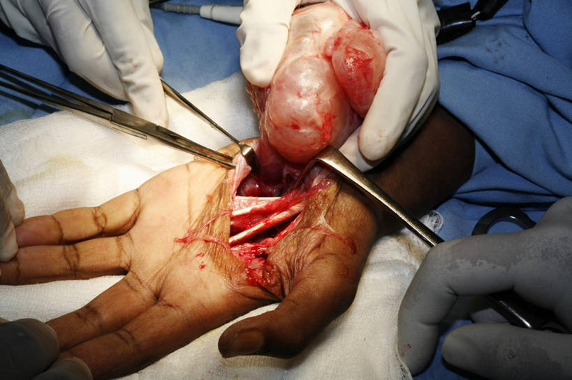 成年人,手,四个人,横图,室内,特写,安全,纱布,防护,骨头,拿着,手套,血液,摄影,保护,部分,手术,伤口,手术室,专心,肿瘤,解剖刀,保险,切断,手术台,医疗工具,外科医生,保全,周全,安稳,安定,防护手套,平安,男人,彩图,神经系统