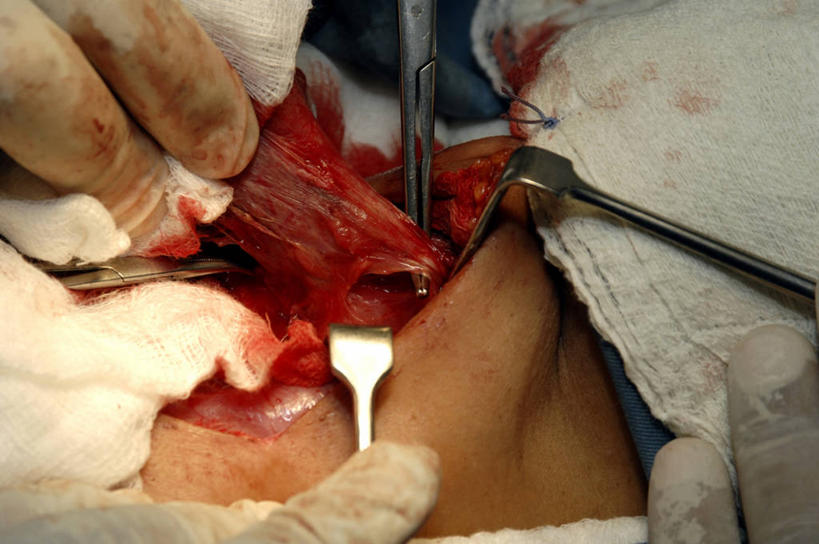 手,两个人,医院,横图,室内,特写,白天,安全,苏丹,镊子,防护,手套,纸巾,血液,摄影,保护,协助,部分,照亮,手术,伤口,手术室,准确,保险,外科医生,保全,周全,安稳,安定,防护手套,甲状腺,技能,平安,彩图