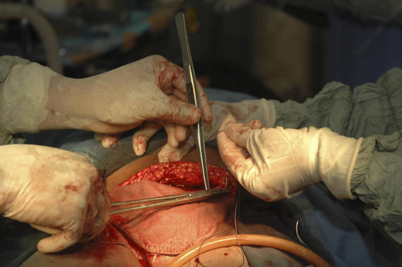 手,横图,俯视,室内,特写,安全,不锈钢,镊子,纱布,防护,拿着,手套,血液,摄影,保护,部分,手术,伤口,手术室,拼接,保险,医疗工具,外科医生,保全,周全,安稳,安定,缝合,防护手套,剖腹产,平安,彩图,高角度拍摄